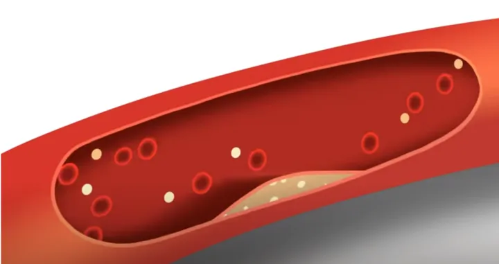 Razvijena vakcina protiv jednog od vodećih uzroka kardiovaskularne bolesti/ Screenshot/ Youtube/