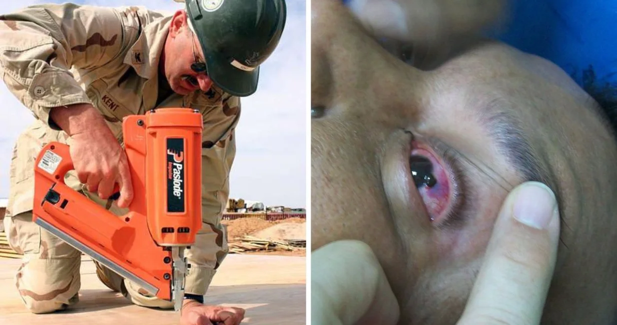 Čovjek sebi ispalio pneumatski pištolj u oko/ Ilustracija/ Wikimedia/Andrej Bjeloš