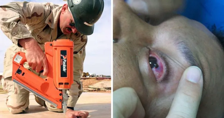 Čovjek sebi ispalio pneumatski pištolj u oko/ Ilustracija/ Wikimedia/Andrej Bjeloš