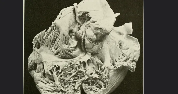 Kalcifikacija srca/ Studies in cardiac pathology/