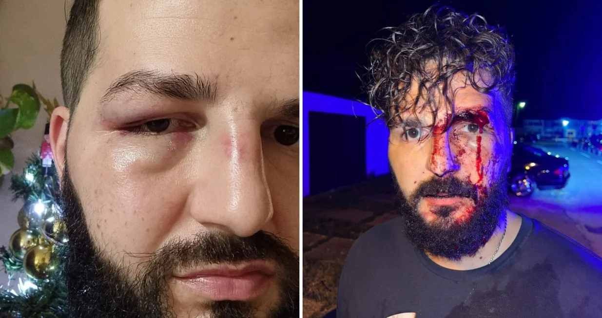 Mirza Dervišević ponovno pretučen/Facebook/Maya S