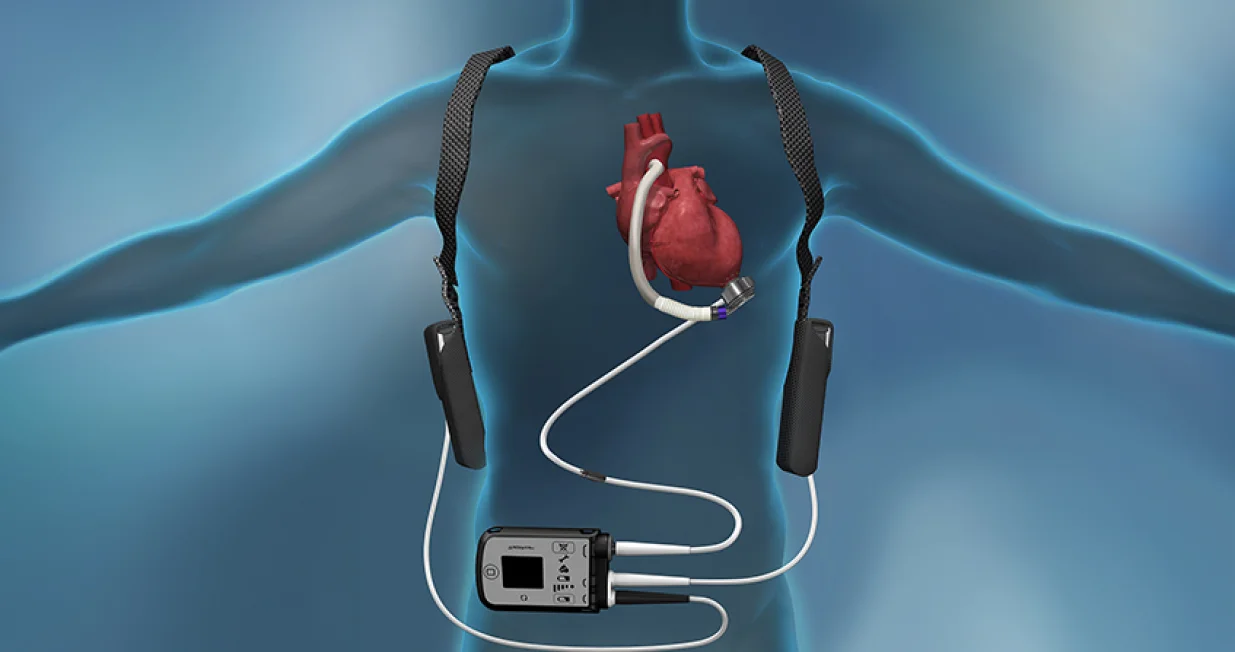 srčana pumpa srceThe University of Kansas Health System/