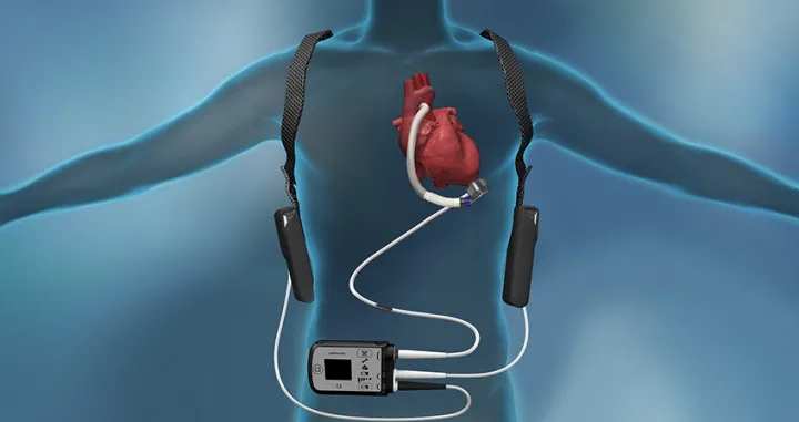 srčana pumpa srceThe University of Kansas Health System/