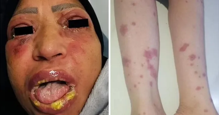 Žena je i ranije uzimala ovaj lijek bez posljedica/ Clinical Case Reports/