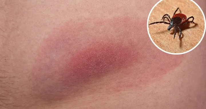 Ubodi krpelja mogu biti vrlo opasni/Amir9937