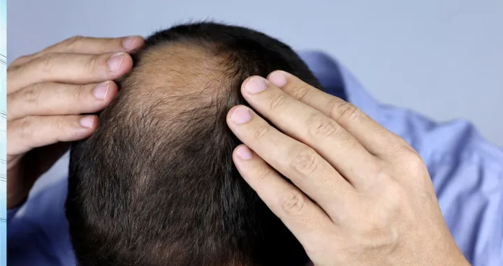 Ketokonazol može pomoći pri opadanju kose/ Ilustracija/