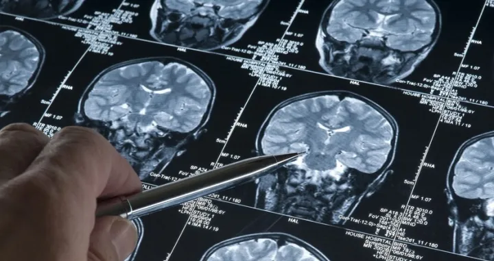 ct mozak, promjene/Ilustracija/- 