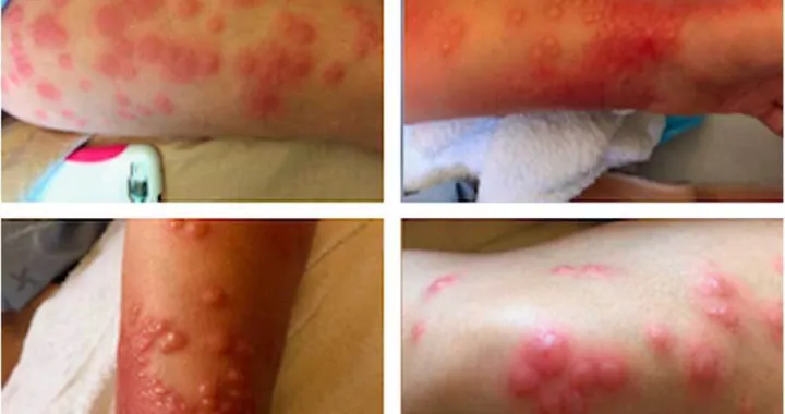 leukemija ilustracija/