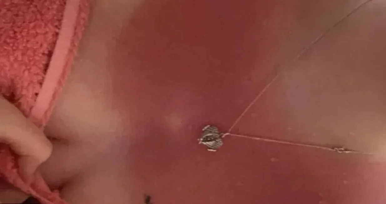 Sunčanje opekotine/Tiktok