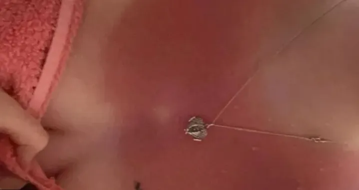 Sunčanje opekotine/Tiktok