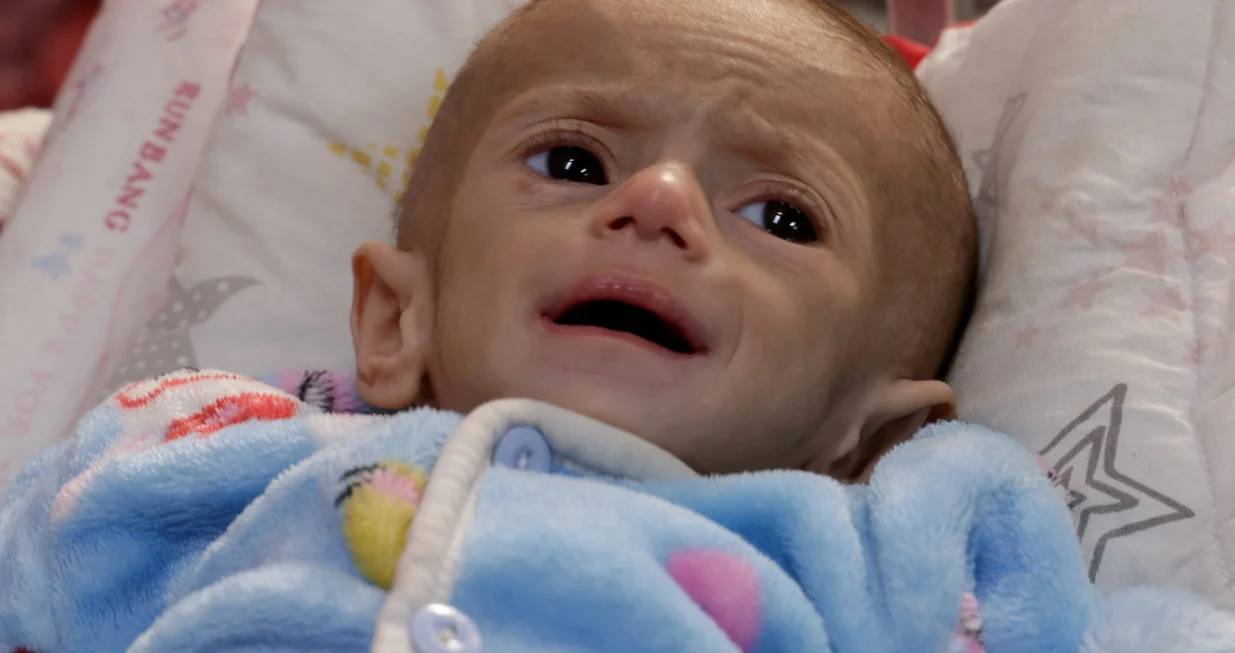A Palestinian girl lies on a bed at Nasser Hospital where she receives treatment, in Khan Younis, in the southern Gaza Strip, April 30, 2025. REUTERS/Hatem Khaled  TPX IMAGES OF THE DAY/Hatem Khaled