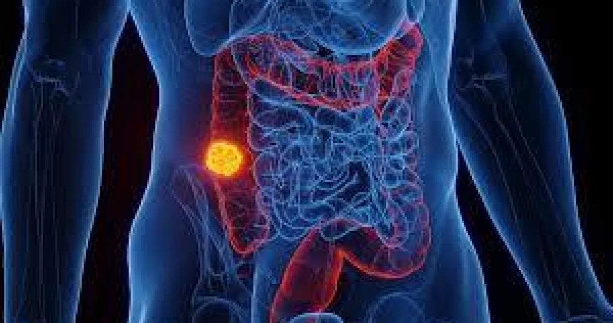 rak debelog crijeva/