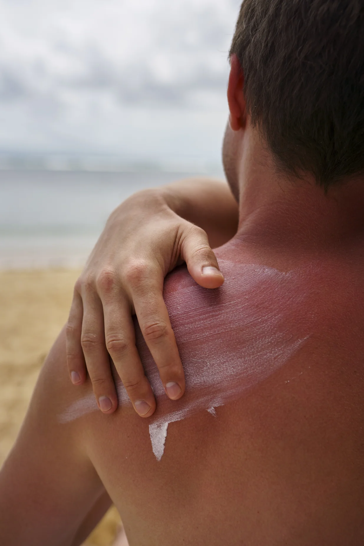 ljeto, sunce, zaštita kože, opekotine/Freepik