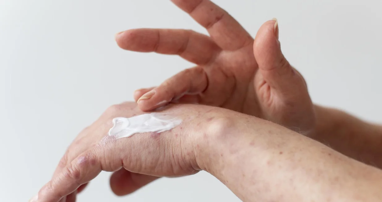 Ovo su najčešći osipi tokom ljeta/Free Pik