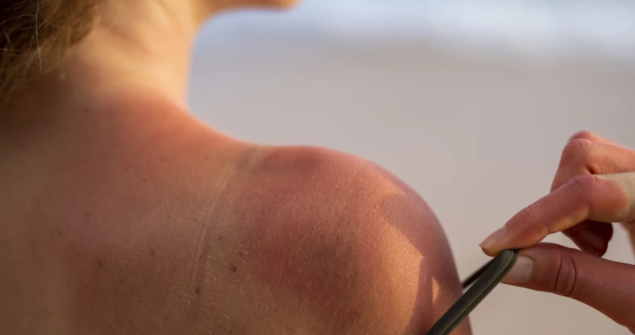 Sunčane opekotine nestaju preko noći/Free Pik