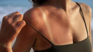 Prva pomoć kod opekotina od sunca/Free Pik