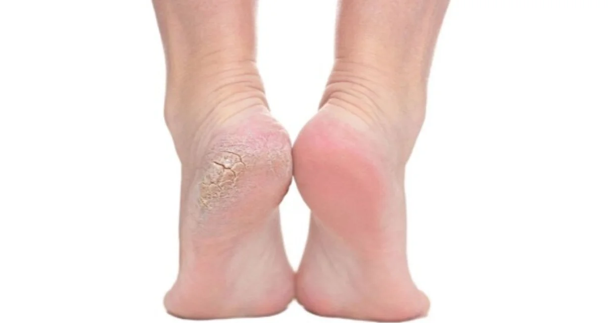 Recite zbogom grubim petama/Pinterest