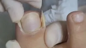 Naučite prepoznati prve simptome/Pinterest