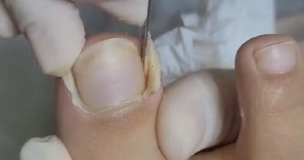 Naučite prepoznati prve simptome/Pinterest