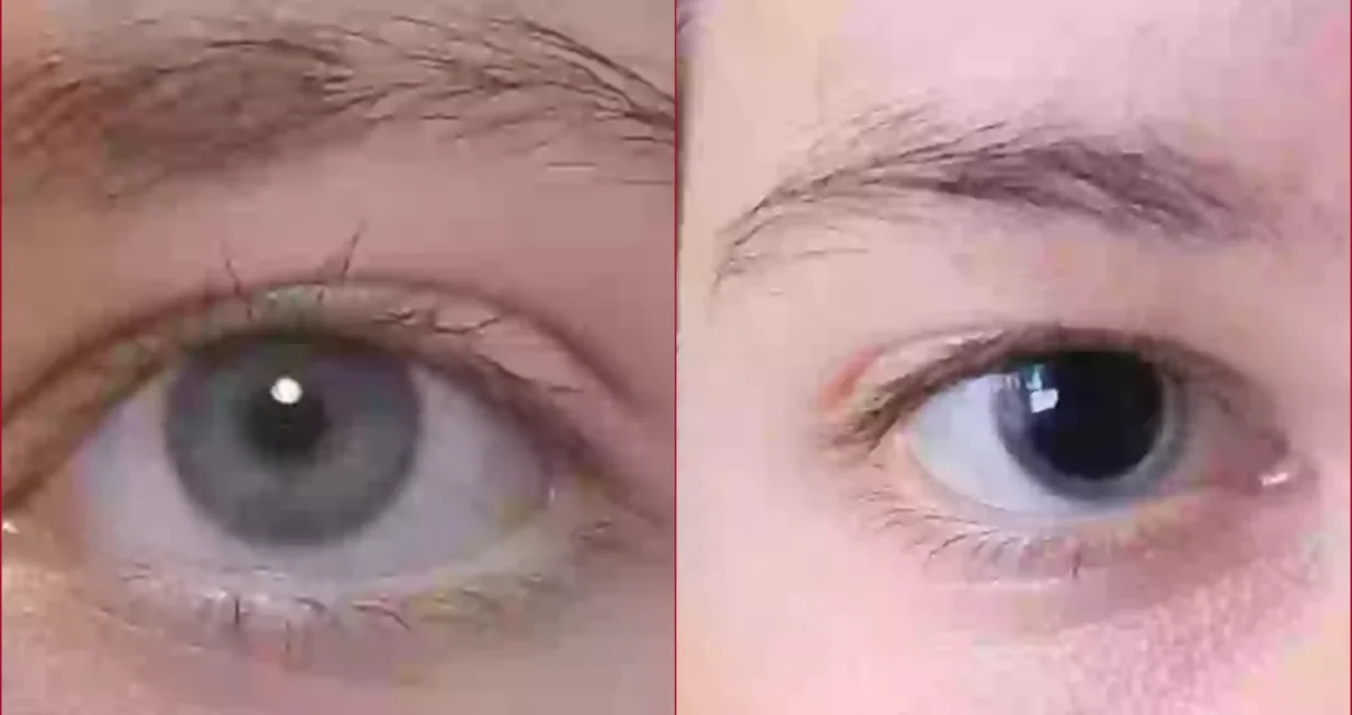 Zjenice i glavobolja joj spasili život: Žena zahvaljujući internetu otkrila ugrušak u mozgu/Reddit