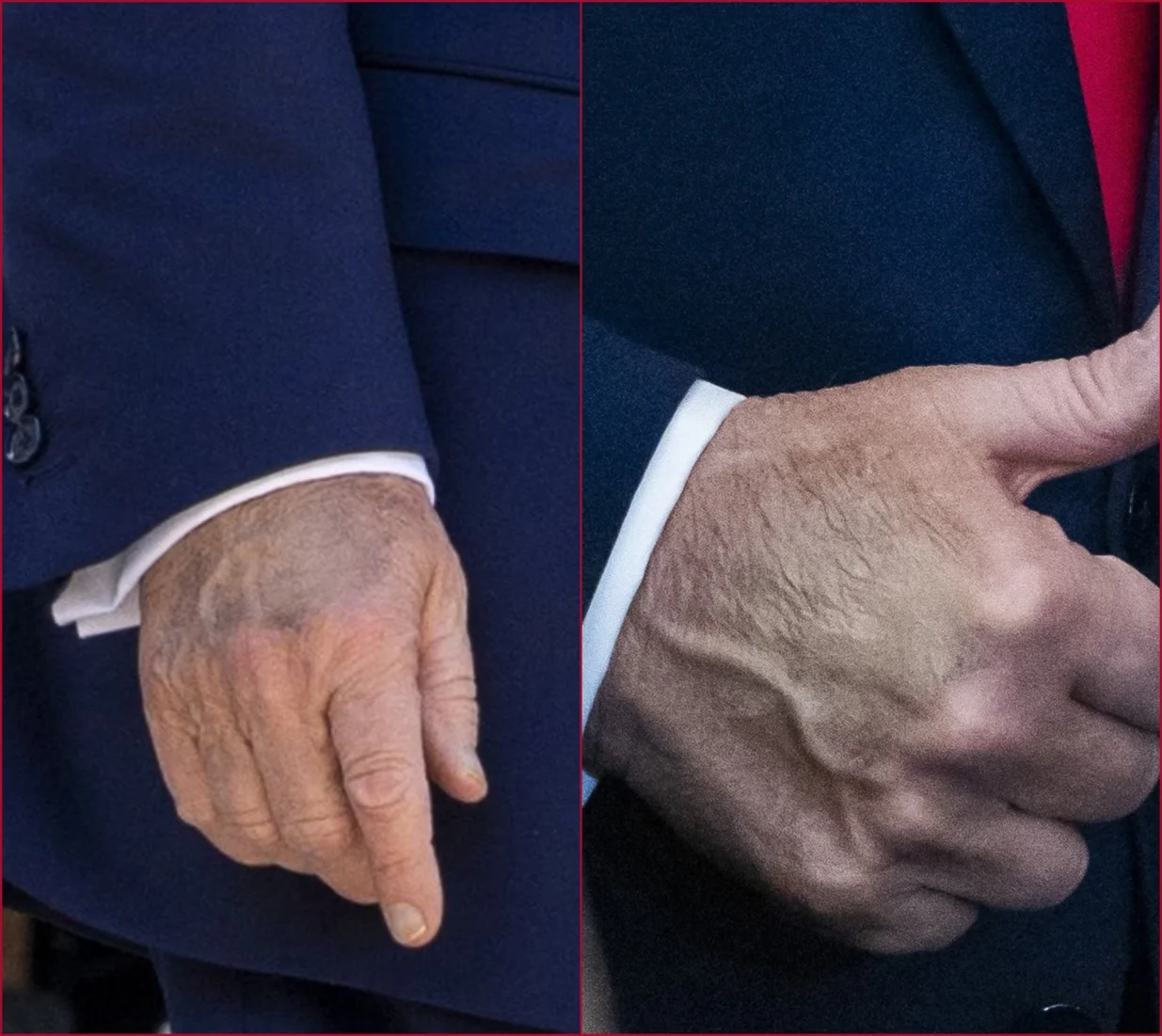 donald trump, modrica, ruka//