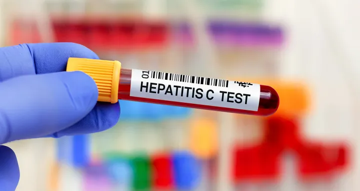 Test na hepatitis C//