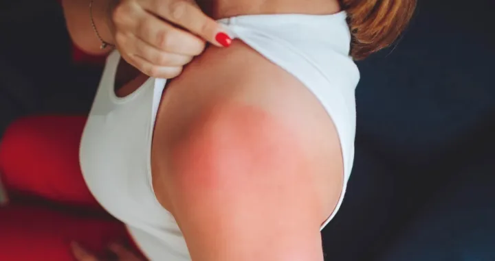 Sunčanje i posljedice/