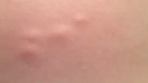 Kvržice koje ne bole mogu biti opasnije nego što mislite/Pinterest