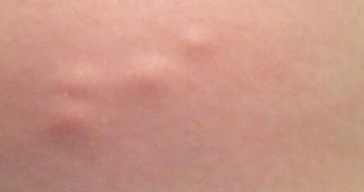 Kvržice koje ne bole mogu biti opasnije nego što mislite/Pinterest