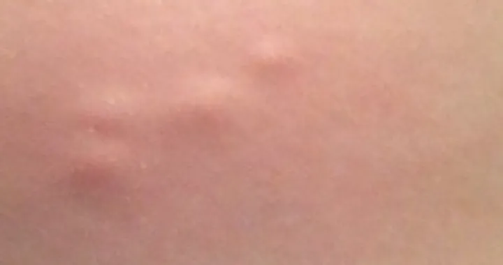 Kvržice koje ne bole mogu biti opasnije nego što mislite/Pinterest