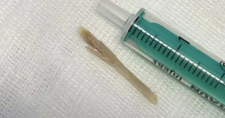 Kost koja je zapela u grlu djevojčice/