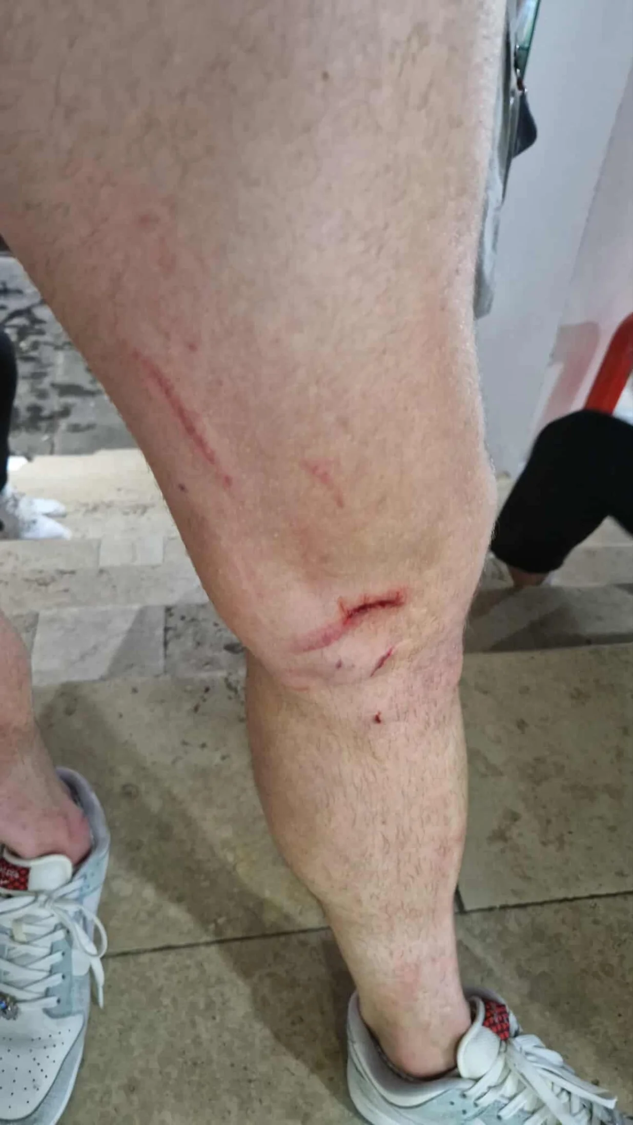 Noga Amara Beganovića/Foto: 