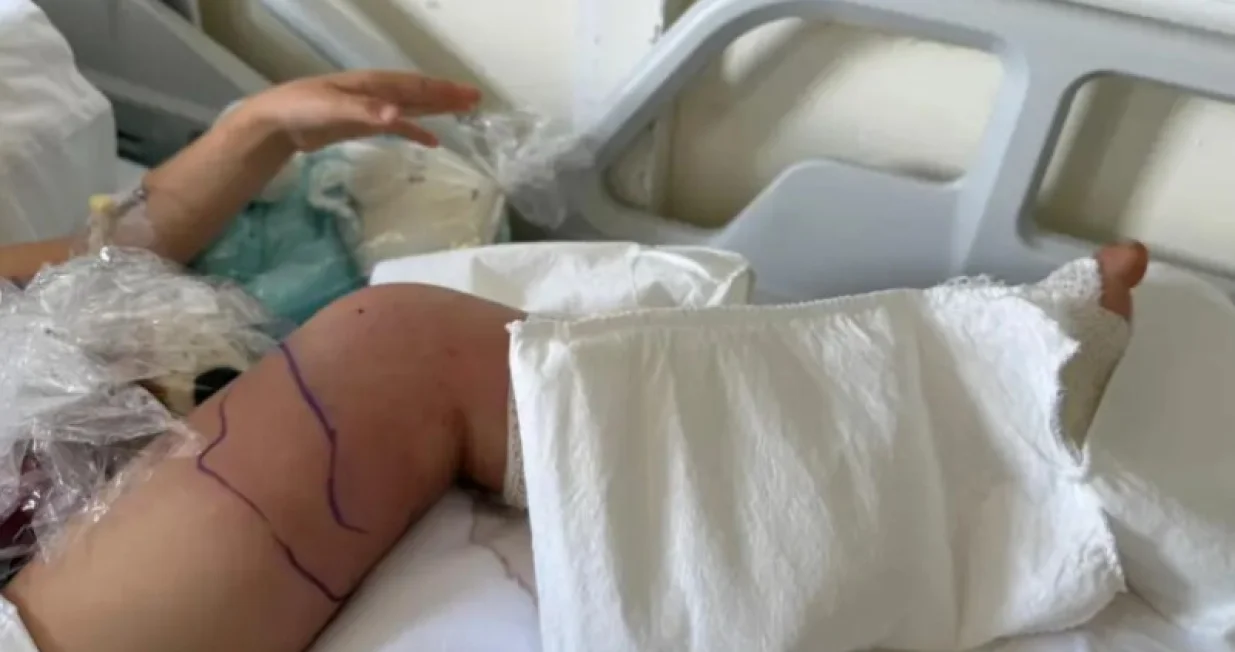  Noga na mjestu ugriza potpuno poplavila/24sata.hr//