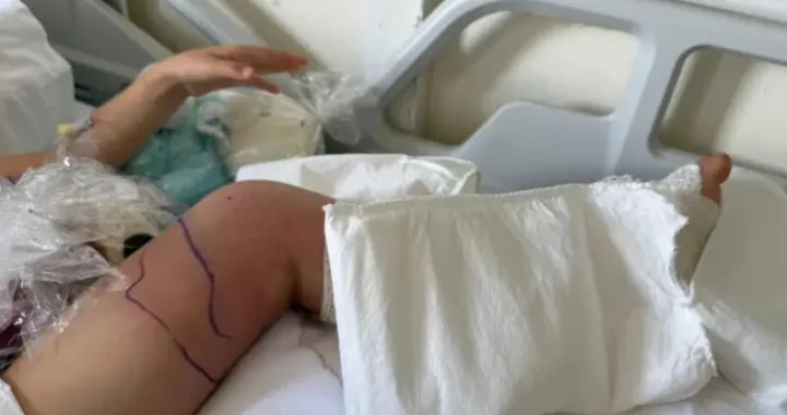  Noga na mjestu ugriza potpuno poplavila/24sata.hr//