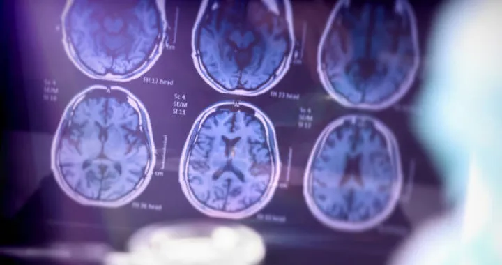 analiza alzheimerove bolesti/Digicomphoto