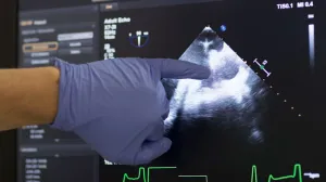 Brojne srčane nepravilnosti/Ilustracija/