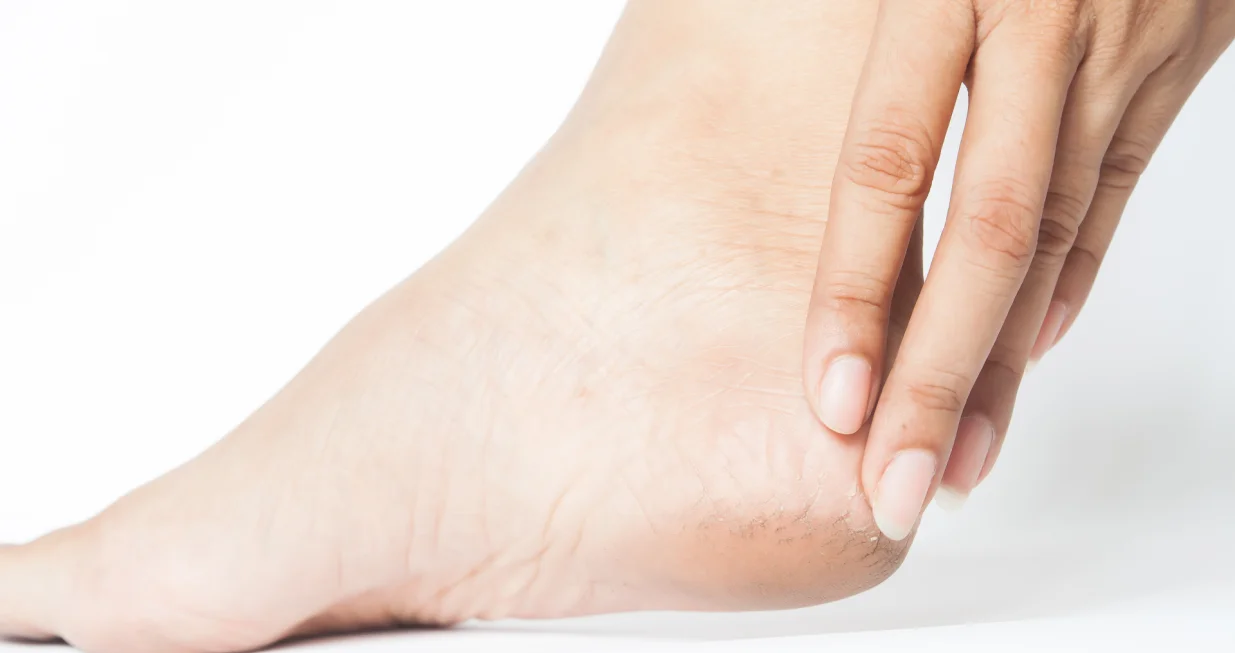 Njega peta prije zime/Free Pik