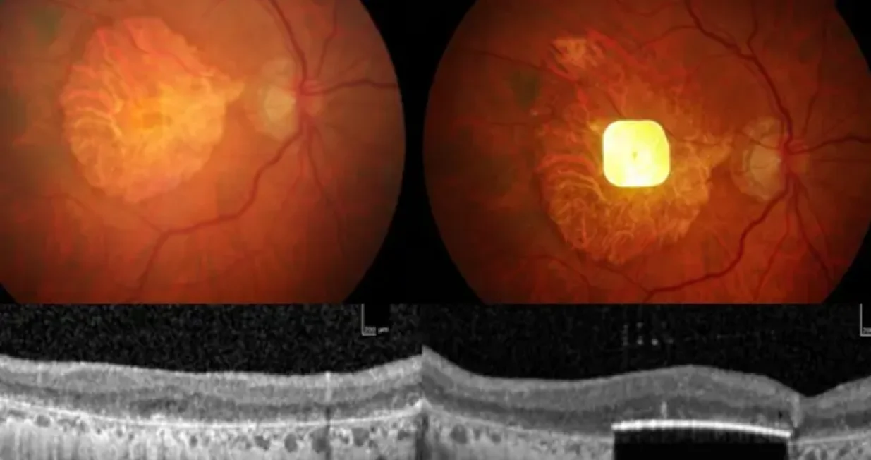 Testiran sićušni čip koji vraća vid, rezultati su odlični/