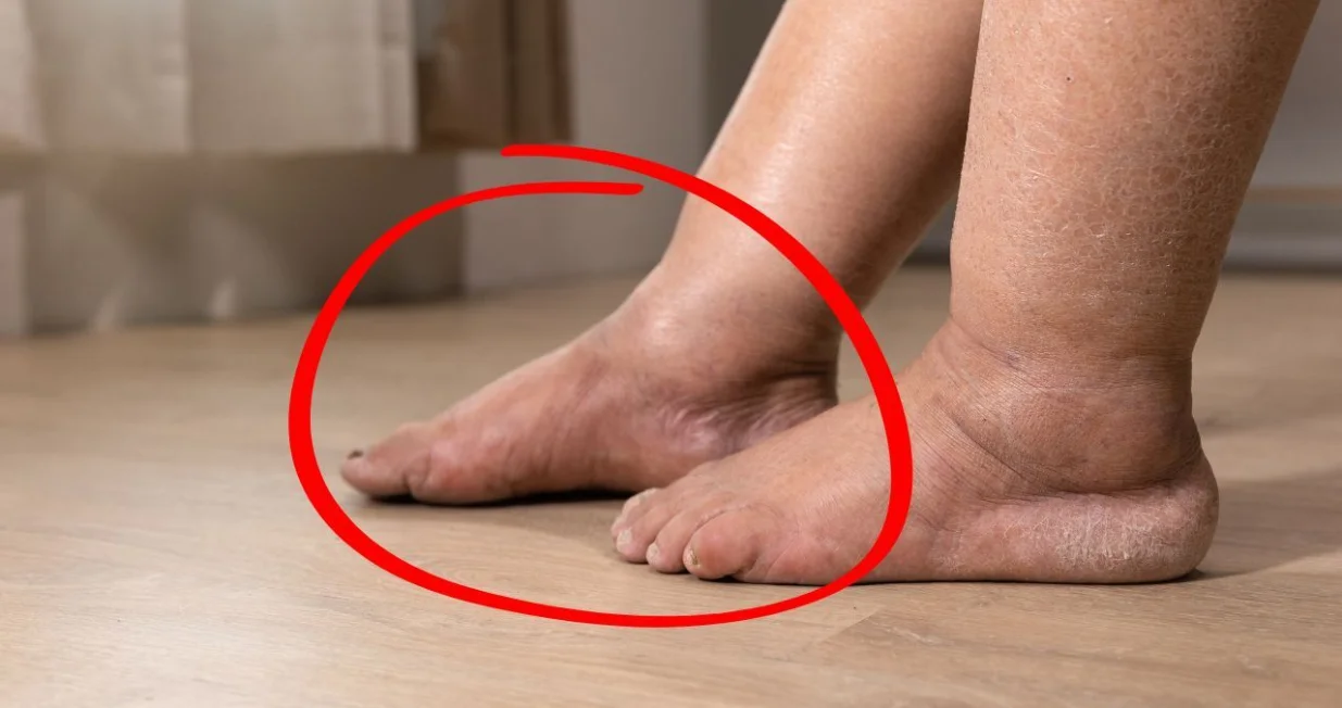 Oticanje nogu je jedan od simptoma bolesti jetre/ Ilustracija/