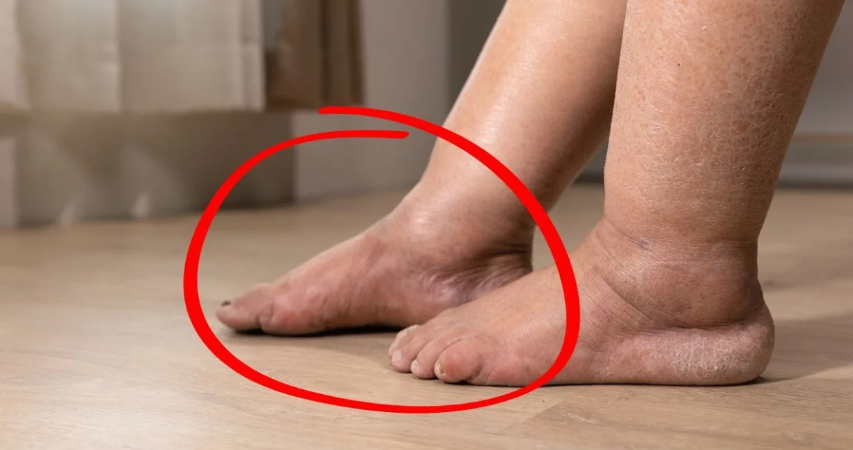 Oticanje nogu je jedan od simptoma bolesti jetre/ Ilustracija/