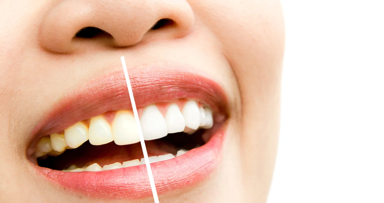 Izbijelite ih na prirodan način/Free Pik