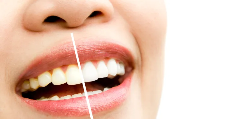 Izbijelite ih na prirodan način/Free Pik