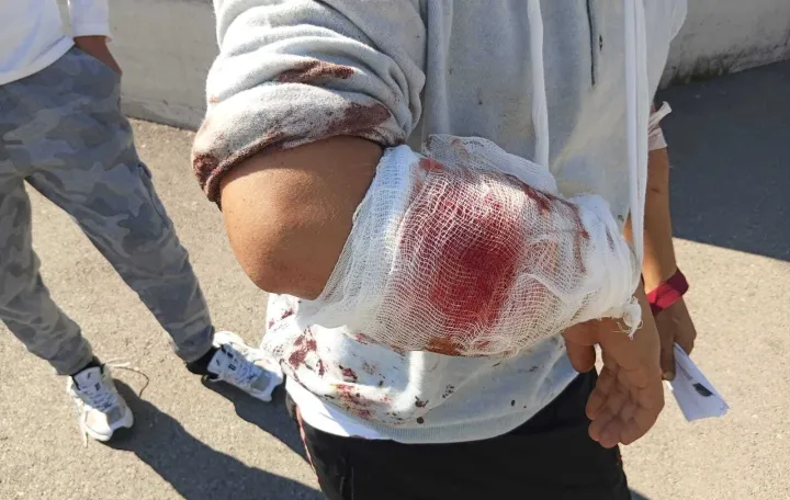 Migrant kojeg su napali hrvatski granični psi/