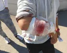 Migrant kojeg su napali hrvatski granični psi/